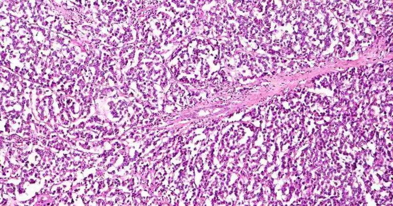 Study: Cannabinoids And Ovarian Cancer